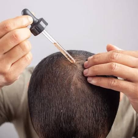 A bottle of minoxidil being applied to a thinning scalp