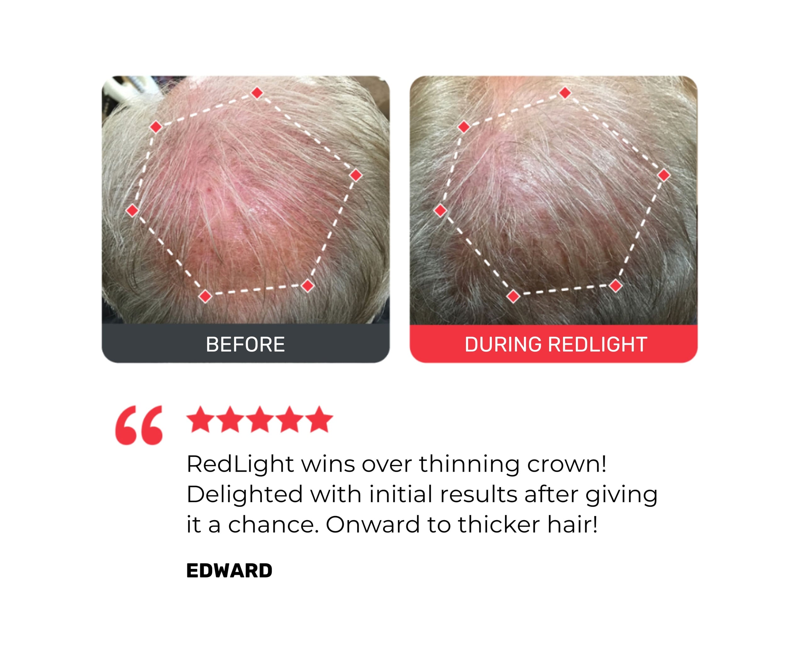 Before and during RedLight treatment comparison of hair thinning on a scalp.