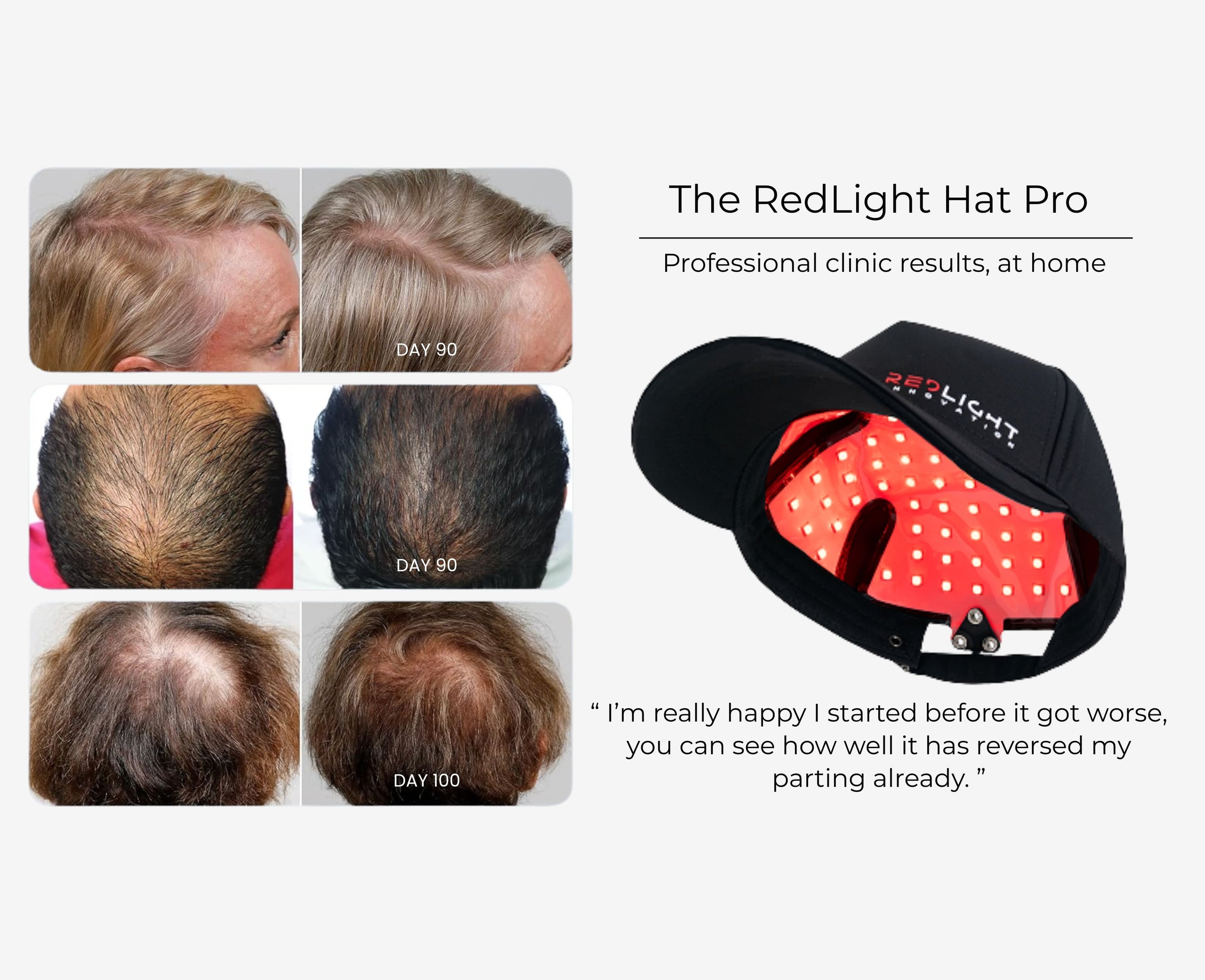 RedLight Hat Pro with before-and-after hair growth results on a white background