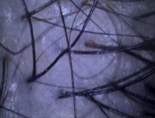 Follicle health at day 90